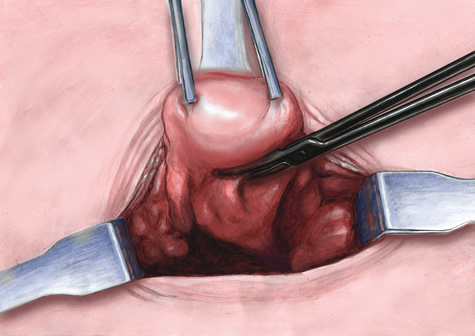 Hysterectomy Scar Vertical. It or vertical incision