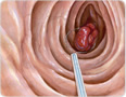 polypectomy