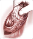 strumectomy 3