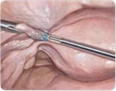 histerektomia laparoskopowa