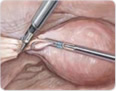 histerektomia laparoskopowa 2