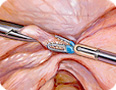 laparoskopia